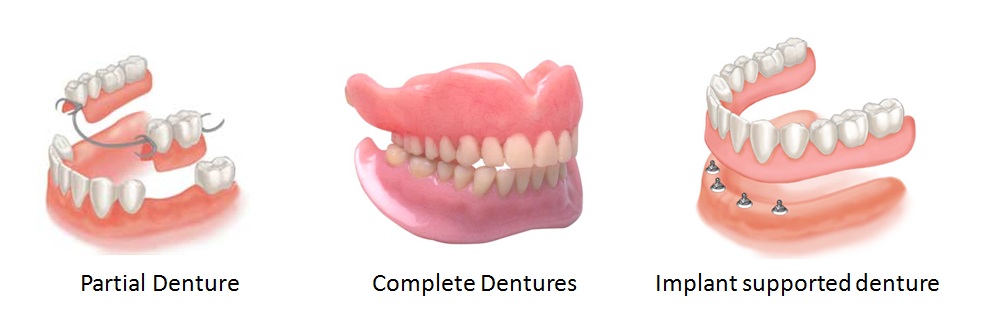 types of dentures